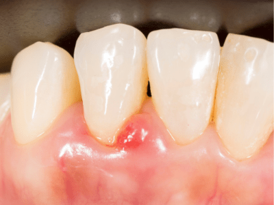 The Connection Between Gingivitis and Alzheimer’s Disease